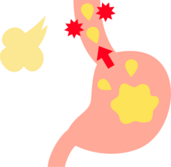 逆流性食道炎を起こしている胃と食道