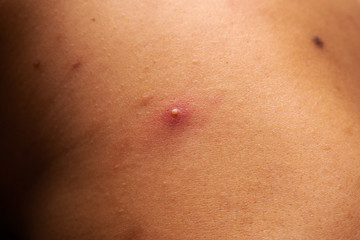 Fototapeta premium Closeup big acne on teenage body. Big abscess on a man’s back.