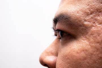 Acne scar on facial skin of asian man. Skin care removal or treatment concept.
