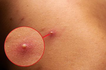 Big acne on teenage body with focus circle. Big abscess on a man’s back.