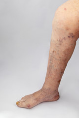 Inflammation of the joints of the lower extremities in an elderly person. Pain syndrome and...
