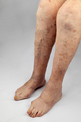 Naklejka premium Inflammation of the joints of the lower extremities in an elderly person. Pain syndrome and deformation of the foot with arthritis. Varicose veins in the legs.