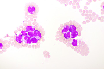Blood picture of acute promyelocytic leukemia or APL, analyze by microscope, original magnification...