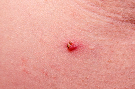 Hanging Nevus Under The Armpit On Human Skin