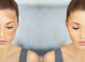 Dark spots, freckles,hyperpigmentation(melasma or chloasma)