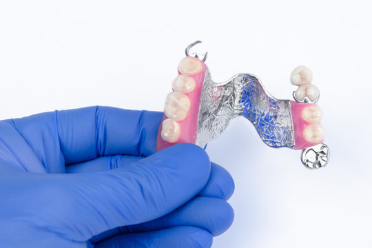 dental prosthetics. orthopedic dentistry. removable dental prosthetics. upper clasp prosthesis with supporting ceramic-metal crowns. dental prosthetics concept