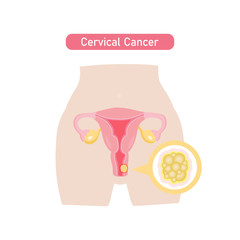 Cervical cancer in flat design.