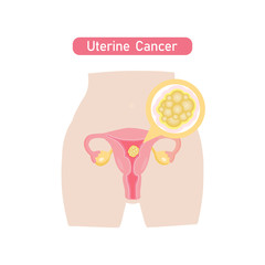Uterine cancer in flat design.
