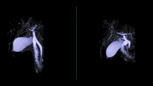 Magnetic resonance cholangiopancreatography or MRCP 3D MIP image to visualize the biliary and pancreatic ducts .