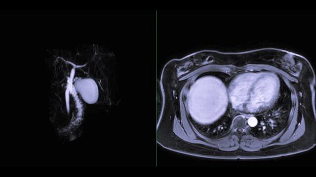 Magnetic resonance cholangiopancreatography or MRCP 3D MIP image compare Axial T1W Post GD to visualize the biliary and pancreatic ducts .