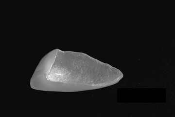  Porcelain Veneers close up. Macro foto