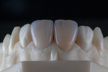  Porcelain Veneers close up. Macro foto