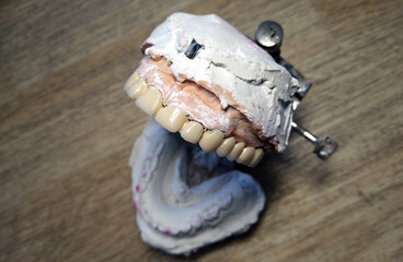 Orthodontist dentist, Dental prosthesis making process
