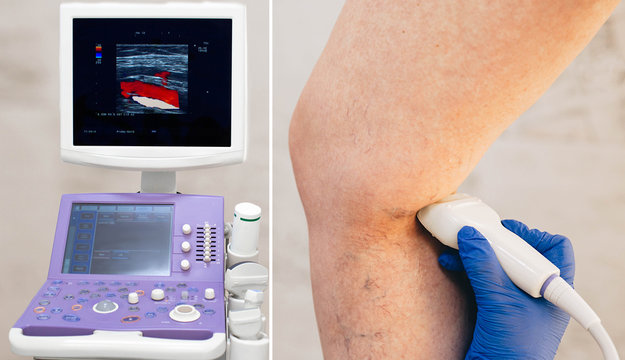 Cropped Ultrasound Exam Veins On The Leg, Vein Thrombosis, Varicose Veins