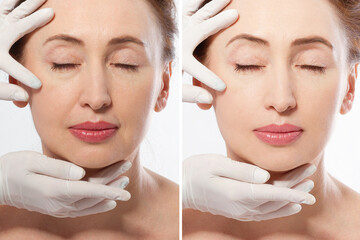 Close up middle age woman macro face before after collagen injection. Face lifting, anti aging...