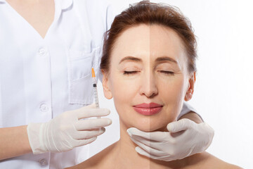 Close up woman face before after lifting injection. Middle age lady before-after wrinkled skin, eye...