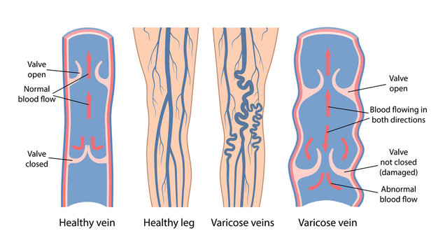 Varicose veins. Image of healthy and diseased legs. A longitudinal section of a vein with a description of the main parts. Vector illustration in flat style