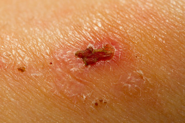 Close up of a scar