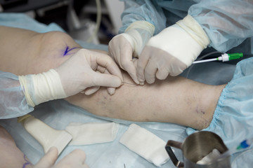 Doctors doing vein surgery procedure