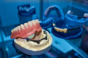 Dentistry. Models of removable dentures. Prosthetics of the dental cavity. Dentures on the jaw. The manufacture of dental prostheses. Prosthetist. Dental technician. - obrazy, fototapety, plakaty