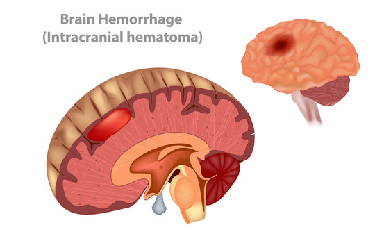 Brain Hemorrhage (Intracranial hematoma) Vector
