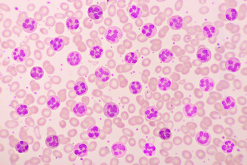 Variation of normal neutrophil cells or PMN cells in blood smear, analyze by microscope, original...