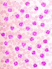 Variation of normal neutrophil cells or PMN cells in blood smear, analyze by microscope, original magnification 1000x