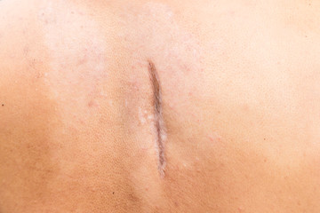 Fototapeta premium Raised scar. scar after appendectomy. cyanotic keloid scar caused by surgery and suturing, skin imperfections or defects. Hypertrophic Scar on skin
