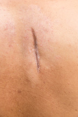 Fototapeta premium Raised scar. scar after appendectomy. cyanotic keloid scar caused by surgery and suturing, skin imperfections or defects. Hypertrophic Scar on skin