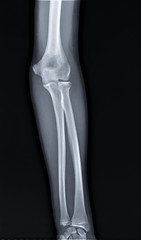 x-ray of the normal elbow joint