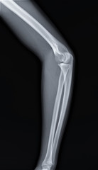 x-ray of the normal elbow joint