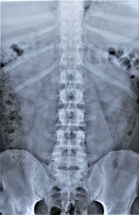 Obraz na płótnie Canvas radiography of lumbar and sacral spine, pelvis, coxarthrosis, medical diagnostics