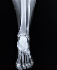 normal radiograph of the ankle joint