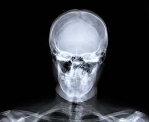 normal x-ray of the skull in direct projection, medical diagnostics, traumatology and orthopedics, neurosurgery