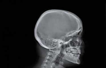 normal x-ray of the skull in lateral projection