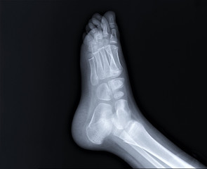 normal radiography of the foot, medical diagnostics, traumatology and orthopedics