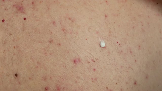 close-up of doctors hands squeeze out medicine cream from a tube and apply to skin with acne. gently putting a drop of ointment on red pimple zit and rubs into skin. 4k UHD video footage