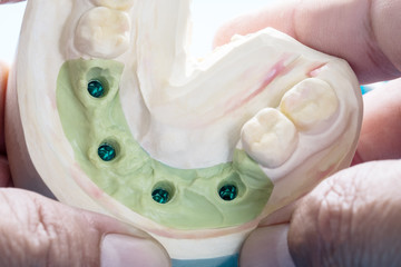 Fototapeta na wymiar Closeup/ Convertible abutment components/ Dental implant temporary abutment/ Abutment screw implant.
