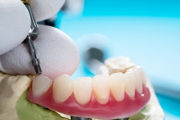 Closeup/ Dental implants supported overdenture on blue background/ Screw retained/ implant restorations.