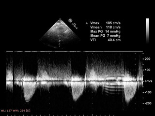 Screen of echocardiography (ultrasound) machine.
