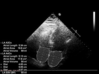 Screen of echocardiography (ultrasound) machine.