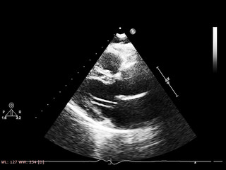 Screen of echocardiography (ultrasound) machine.