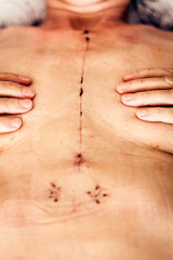 Naklejka premium Scar from open heart surgery on the female body, where the sternum was cut in two, and the rib cage sprung. Image taken 30 days (1 month) following surgery.