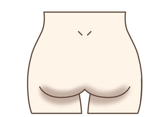 お尻黒ずみ