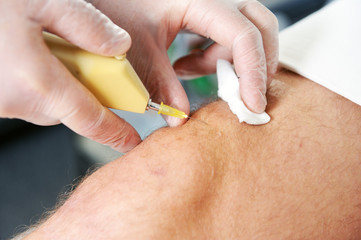 Carbon dioxide therapy (carboxytherapy). Skin rejuvenation.The procedure is performed on the male knee.