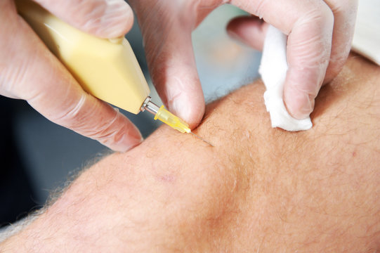 Microinject Needle รูปภาพMicroinjection – เลือกดูภาพถ่ายสต็อก เวกเตอร์ และวิดีโอ154 ...
