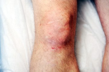 Naklejka premium Reddened skin on the knee after carbon dioxide therapy (carboxytherapy)