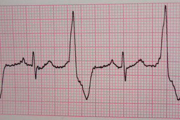 Heartbeats recorded on an electrocardiogram. cardiac arrhythmia.