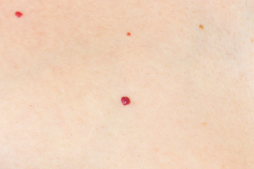 angioma. red mole on the skin. bursting vessel capillary. many angiomas in a small area of...