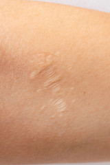 Fototapeta premium old scar on human skin. sewn scar, four sutures. laceration, suturing.